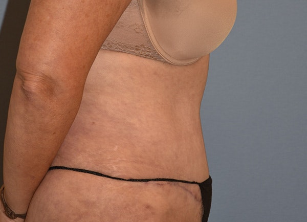 Tummy Tuck Before & After Gallery - Patient 120913 - Image 4