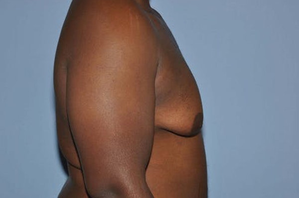 Gynecomastia Before & After Gallery - Patient 306025 - Image 5