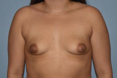 Breast Augmentation Before & After Gallery - Patient 312838 - Image 1