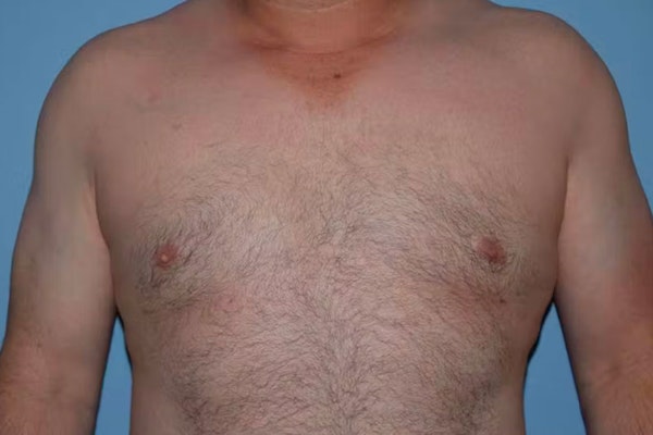 Gynecomastia Before & After Gallery - Patient 186110 - Image 2