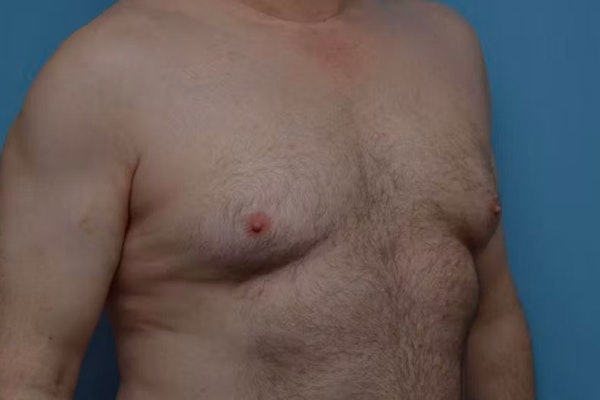 Gynecomastia Before & After Gallery - Patient 186110 - Image 3