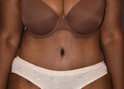 Tummy Tuck Before & After Gallery - Patient 364084 - Image 2