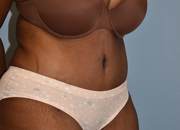 Tummy Tuck Before & After Gallery - Patient 364084 - Image 4