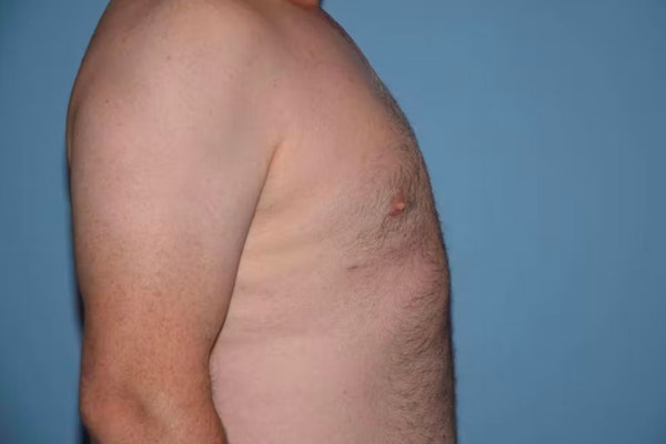 Gynecomastia Before & After Gallery - Patient 186110 - Image 6