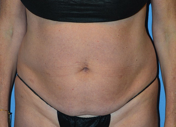 Liposuction Before & After Gallery - Patient 107111 - Image 1