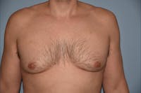 Gynecomastia Before & After Gallery - Patient 357728 - Image 1