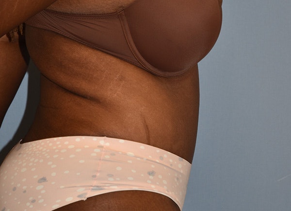Tummy Tuck Before & After Gallery - Patient 364084 - Image 6