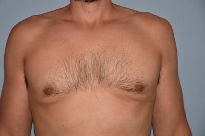 Gynecomastia Before & After Gallery - Patient 357728 - Image 2