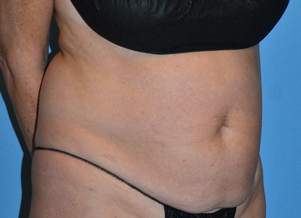 Liposuction Before & After Gallery - Patient 107111 - Image 3