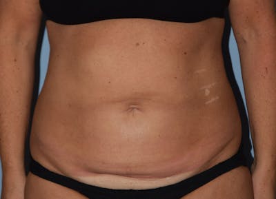 Tummy Tuck Before & After Gallery - Patient 417563 - Image 1