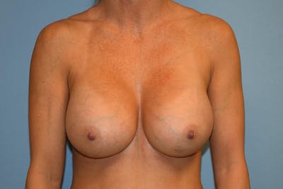 Breast Augmentation Before & After Gallery - Patient 298567 - Image 2