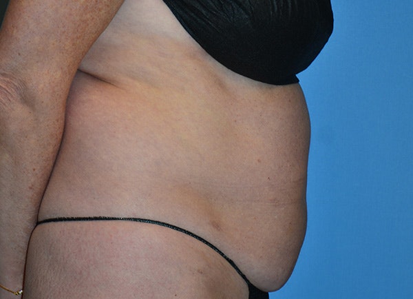 Liposuction Before & After Gallery - Patient 107111 - Image 5