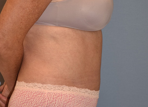 Liposuction Before & After Gallery - Patient 107111 - Image 6