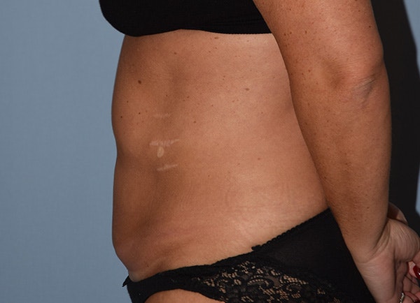 Tummy Tuck Before & After Gallery - Patient 417563 - Image 5