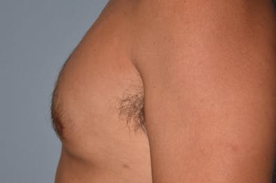 Gynecomastia Before & After Gallery - Patient 357728 - Image 6