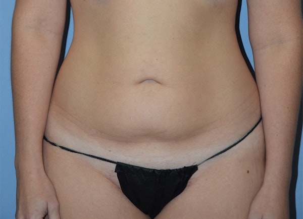 Tummy Tuck Before & After Gallery - Patient 400096 - Image 1