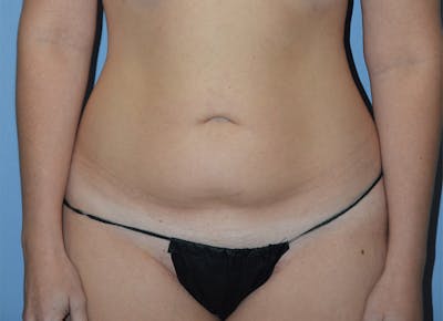 Tummy Tuck Before & After Gallery - Patient 400096 - Image 1