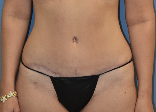 Tummy Tuck Before & After Gallery - Patient 400096 - Image 2