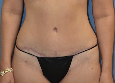 Tummy Tuck Before & After Gallery - Patient 400096 - Image 2