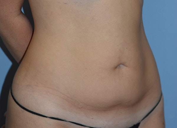 Tummy Tuck Before & After Gallery - Patient 400096 - Image 3