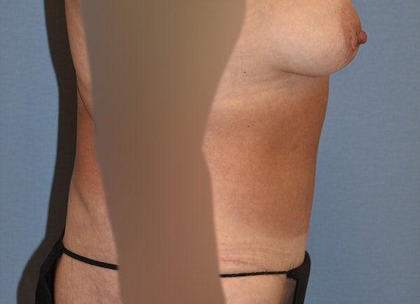 Liposuction Before & After Gallery - Patient 396203 - Image 5