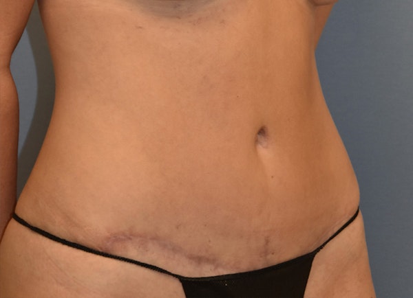 Tummy Tuck Before & After Gallery - Patient 400096 - Image 4
