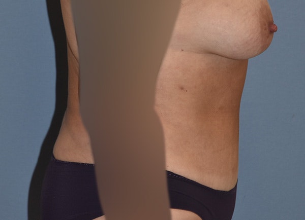 Liposuction Before & After Gallery - Patient 396203 - Image 6