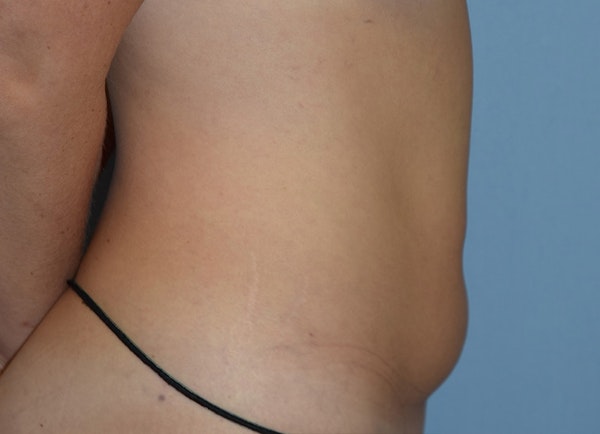 Tummy Tuck Before & After Gallery - Patient 400096 - Image 5