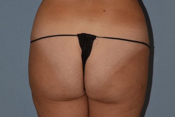 Brazilian Butt Lift Before & After Gallery - Patient 188615 - Image 1