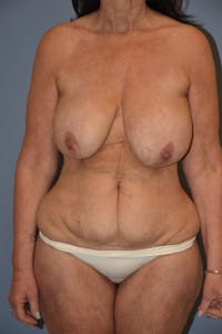 Mommy Makeover Before & After Gallery - Patient 166168 - Image 1
