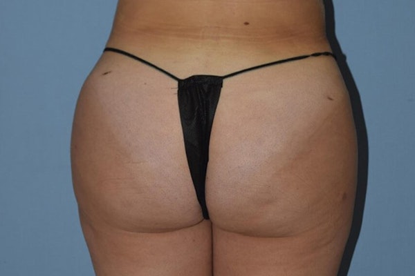 Brazilian Butt Lift Before & After Gallery - Patient 188615 - Image 2
