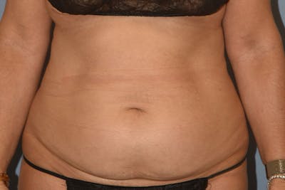 Tummy Tuck Before & After Gallery - Patient 258782 - Image 1