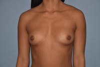 Breast Augmentation Before & After Gallery - Patient 369252 - Image 1