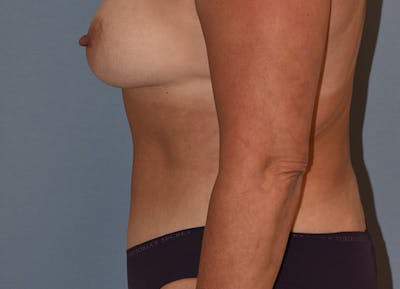 Liposuction Before & After Gallery - Patient 396203 - Image 10