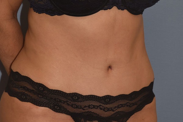 Tummy Tuck Before & After Gallery - Patient 258782 - Image 4
