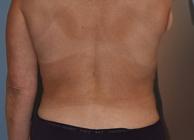 Liposuction Before & After Gallery - Patient 396203 - Image 12