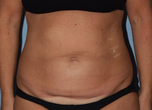 Liposuction Before & After Gallery - Patient 152116 - Image 1