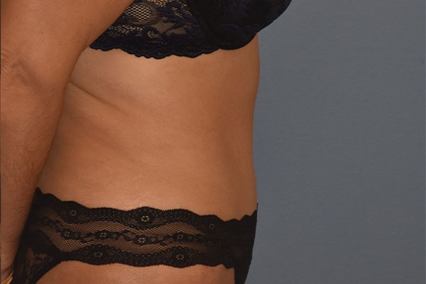 Tummy Tuck Before & After Gallery - Patient 258782 - Image 6