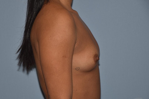 Breast Augmentation Before & After Gallery - Patient 369252 - Image 5