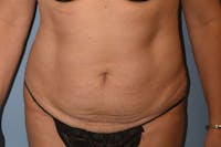 Tummy Tuck Before & After Gallery - Patient 697268 - Image 1