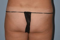 Brazilian Butt Lift Before & After Gallery - Patient 340202 - Image 1