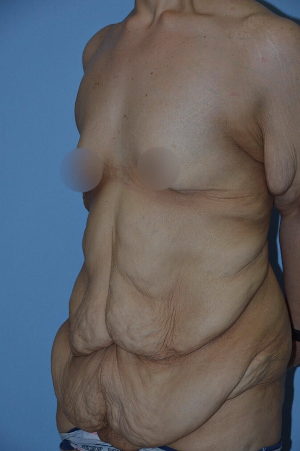 After Weight Loss Surgery Before & After Gallery - Patient 295025 - Image 3