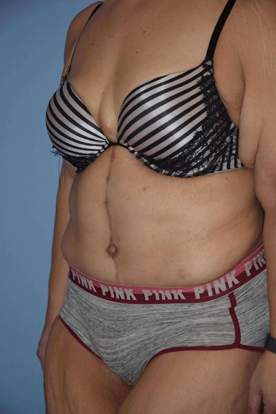 After Weight Loss Surgery Before & After Gallery - Patient 295025 - Image 4