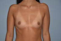 Breast Augmentation Before & After Gallery - Patient 171107 - Image 1