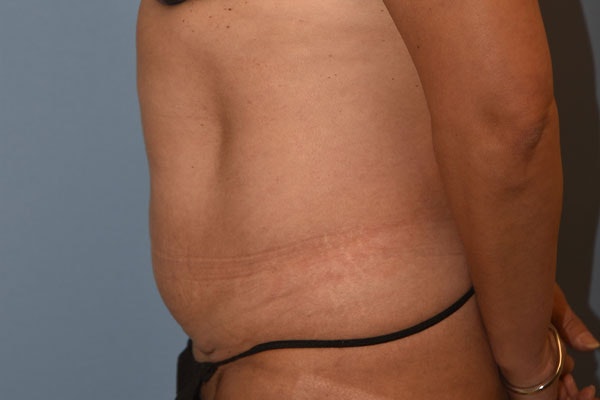 Tummy Tuck Before & After Gallery - Patient 697268 - Image 5
