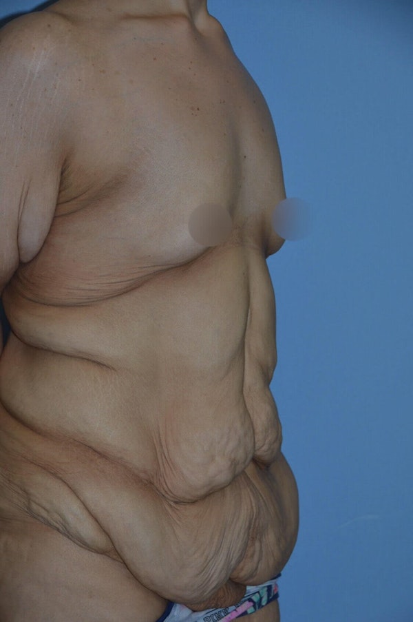 After Weight Loss Surgery Before & After Gallery - Patient 295025 - Image 7