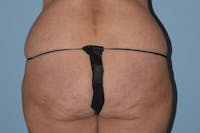 Brazilian Butt Lift Before & After Gallery - Patient 264538 - Image 1