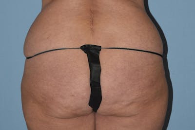 Brazilian Butt Lift Before & After Gallery - Patient 264538 - Image 1