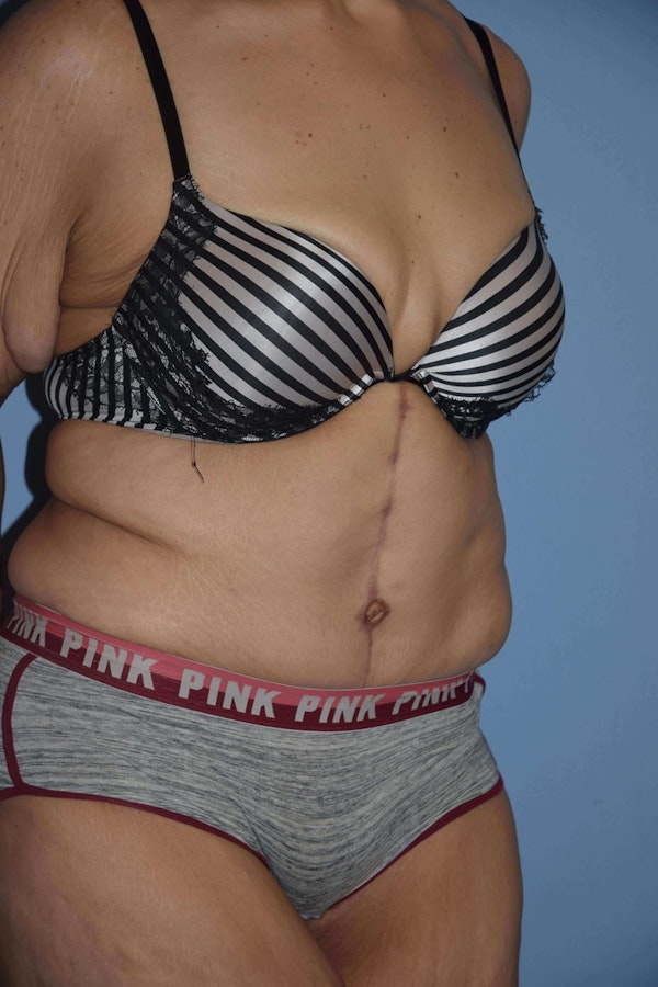 After Weight Loss Surgery Before & After Gallery - Patient 295025 - Image 8