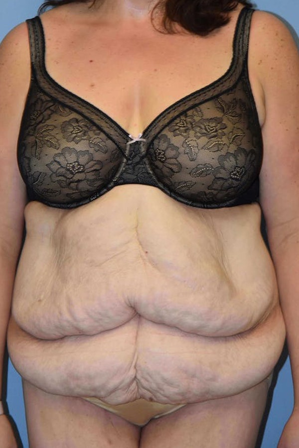 After Weight Loss Surgery Before & After Gallery - Patient 720011 - Image 1